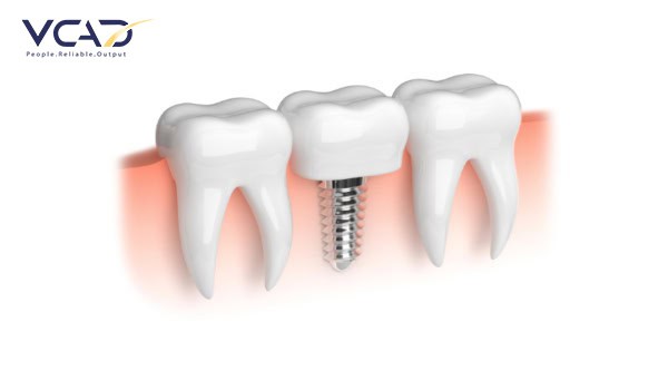 Dental Implant