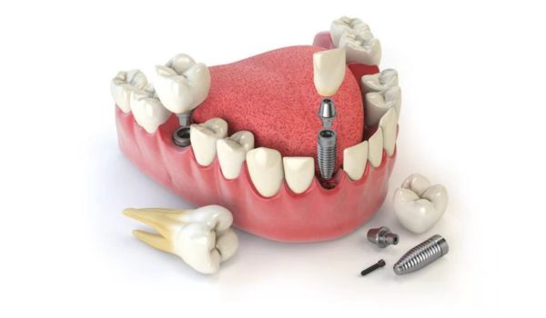 Giải pháp công nghệ phục hình