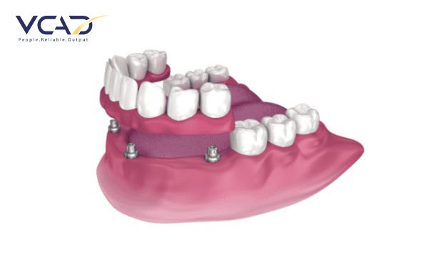 Innovations in Dental Restoration Techniques